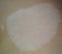 泉州中科白癜风医院靠谱吗-排名一览前十:泛发型白癜风什么症状？
