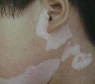 泉州哪里治疗白癜风好-健康资讯:泛发型白癜风辅助治疗有哪些?