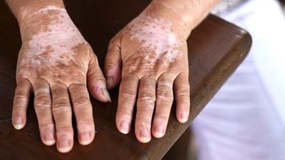 泉州晋江专科白癜风医院-健康科普：屁股上长了个白斑？